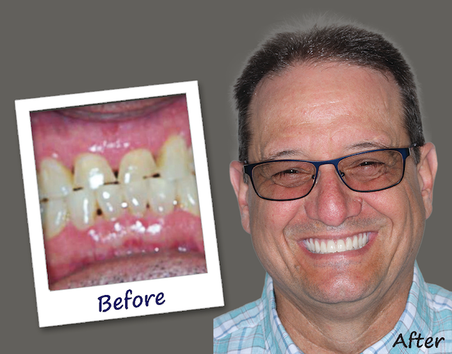 All-On-4 Implants Solution - Indianapolis Oral Surgery & Dental Implant  Center