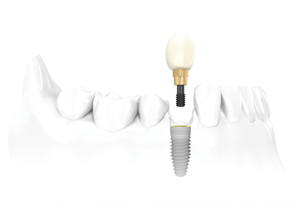 Dental-Implants-Indianapolis